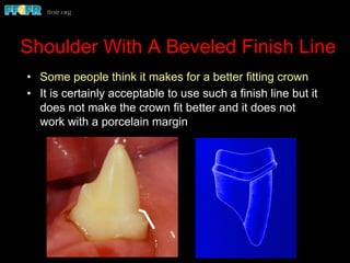 Shoulder With A Beveled Finish Line
•  Some people think it makes for a better fitting crown
•  It is certainly acceptable to use such a finish line but it
does not make the crown fit better and it does not
work with a porcelain margin
 