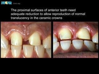 The proximal surfaces of anterior teeth need
adequate reduction to allow reproduction of normal
translucency in the ceramic crowns
 