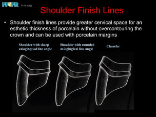 Shoulder Finish Lines
•  Shoulder finish lines provide greater cervical space for an
esthetic thickness of porcelain without overcontouring the
crown and can be used with porcelain margins
Shoulder with sharp
axiogingival line angle
Shoulder with rounded
axiogingival line angle
Chamfer
 