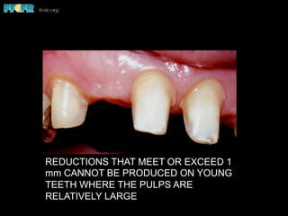 REDUCTIONS THAT MEET OR EXCEED 1
mm CANNOT BE PRODUCED ON YOUNG
TEETH WHERE THE PULPS ARE
RELATIVELY LARGE
 