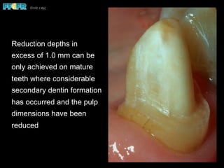 Reduction depths in
excess of 1.0 mm can be
only achieved on mature
teeth where considerable
secondary dentin formation
has occurred and the pulp
dimensions have been
reduced
 
