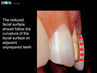 The reduced
facial surface
should follow the
curvature of the
facial surface on
adjacent
unprepared teeth
 