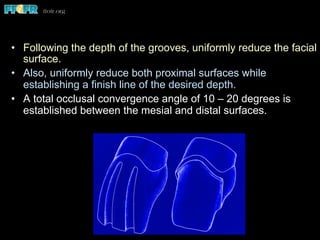 •  Following the depth of the grooves, uniformly reduce the facial
surface.
•  Also, uniformly reduce both proximal surfaces while
establishing a finish line of the desired depth.
•  A total occlusal convergence angle of 10 – 20 degrees is
established between the mesial and distal surfaces.
 
