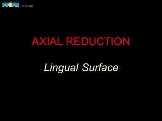 AXIAL REDUCTION
Lingual Surface
 