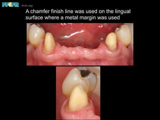 A chamfer finish line was used on the lingual
surface where a metal margin was used
 