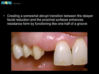 •  Creating a somewhat abrupt transition between the deeper
facial reduction and the proximal surfaces enhances
resistance form by functioning like one-half of a groove
 