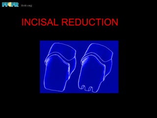 INCISAL REDUCTION
 
