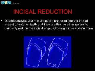 •  Depths grooves, 2.0 mm deep, are prepared into the incisal
aspect of anterior teeth and they are then used as guides to
uniformly reduce the incisal edge, following its mesiodistal form
INCISAL REDUCTION
 