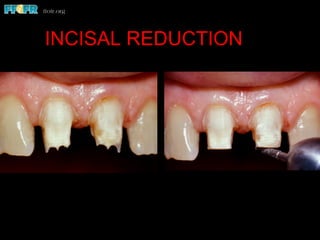 INCISAL REDUCTION
 