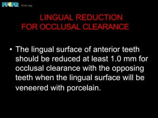 •  The lingual surface of anterior teeth
should be reduced at least 1.0 mm for
occlusal clearance with the opposing
teeth when the lingual surface will be
veneered with porcelain.
LINGUAL REDUCTION
FOR OCCLUSAL CLEARANCE
 