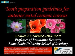Tooth preparation guidelines for
anterior metal ceramic crowns
Charles J. Goodacre, DDS, MSD
Professor of Restorative Dentistry
Loma Linda University School of Dentistry
This program of instruction is protected by copyright ©. No portion of this
program of instruction may be reproduced, recorded or transferred by any
means electronic, digital, photographic, mechanical etc., or by any information
storage or retrieval system, without prior permission.
 