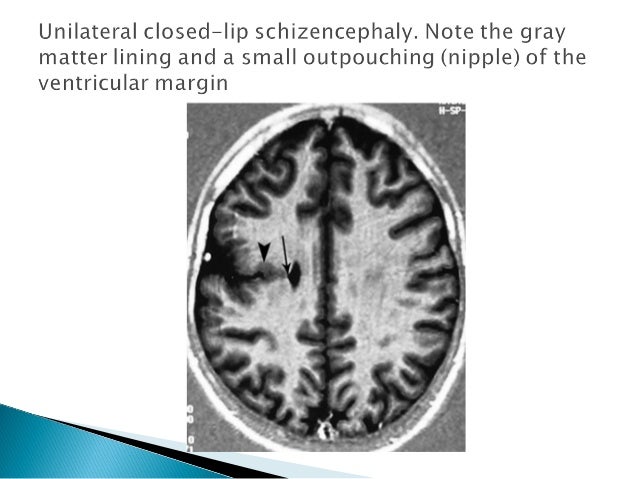 1schizencephaly 2holoprosencephaly 3porencephaly