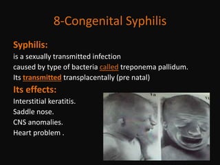 saddle nose syphilis baby