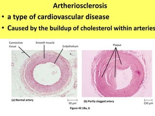 Artheriosclerosis
• a type of cardiovascular disease
• Caused by the buildup of cholesterol within arteries
Figure 42.18a, b
(a) Normal artery (b) Partly clogged artery
50 µm 250 µm
Smooth muscleConnective
tissue Endothelium Plaque
 