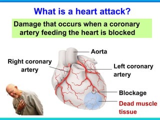 Damage that occurs when a coronary
artery feeding the heart is blocked
What is a heart attack?
Right coronary
artery
Aorta
Left coronary
artery
Blockage
Dead muscle
tissue
 