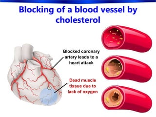 Blocking of a blood vessel by
cholesterol
Blocked coronary
artery leads to a
heart attack
Dead muscle
tissue due to
lack of oxygen
 