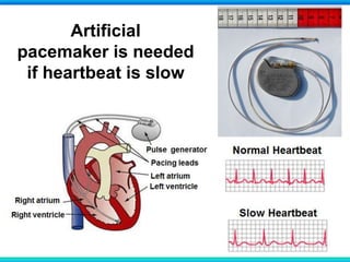 Artificial
pacemaker is needed
if heartbeat is slow
 