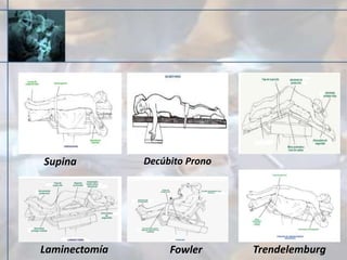 Supina Decúbito Prono
Fowler TrendelemburgLaminectomía
 