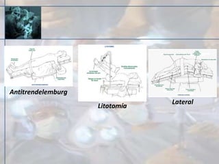 Antitrendelemburg
Litotomía
Lateral
 