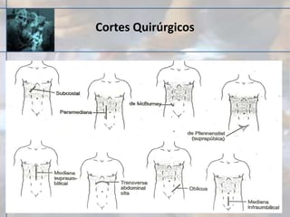 Cortes Quirúrgicos
 