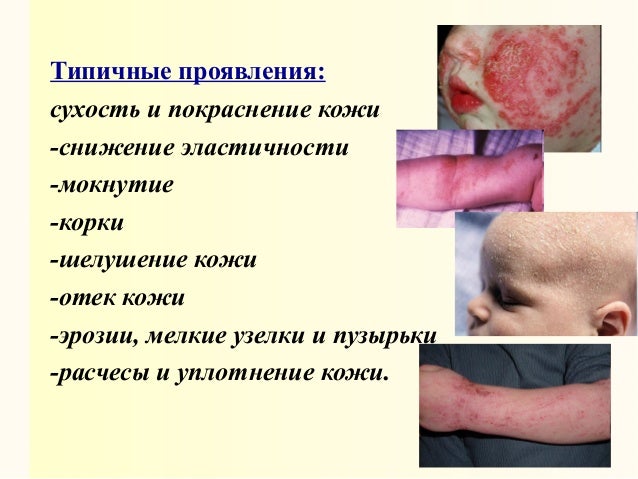 У вестов аллергия