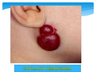  Site - Skin , Mucosa , Viscera (Liver)
 Morphology  Red-Blue , compressible , Spongy , well
defined lesions , 2 - 3 cm...