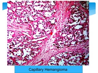 Cavernous Hemangioma: spleen
 