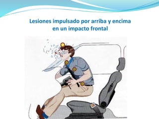 Lesiones impulsado por arriba y encima
en un impacto frontal
 