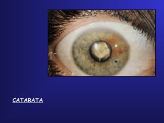 CATARATA
 
