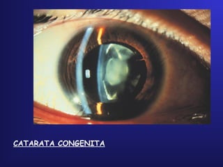 CATARATA CONGENITA
 
