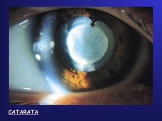 CATARATA
 