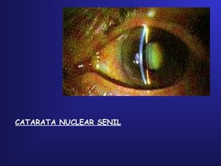 CATARATA NUCLEAR SENIL
 