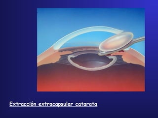 Extracción extracapsular catarata
 