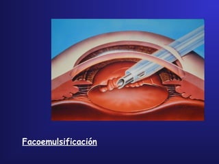 Facoemulsificación
 