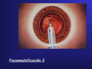 Facoemulsificación 2
 