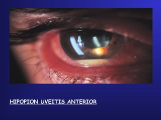 HIPOPION UVEITIS ANTERIOR
 