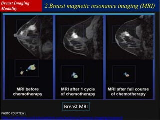 Breast MRI
PHOTO COURTESY :
http://radiology.ucsf.edu/patient-care/sections/womens-imaging/research
2.Breast magnetic resonance imaging (MRI)
Breast Imaging
Modality
 