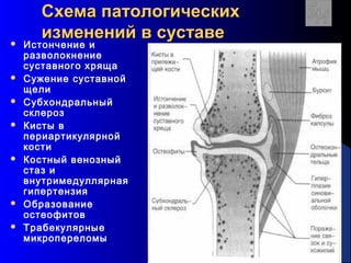 14
Схема патологическихСхема патологических
изменений в суставеизменений в суставе Истончение и
разволокнение
суставного хряща
 Сужение суставной
щели
 Субхондральный
склероз
 Кисты в
периартикулярной
кости
 Костный венозный
стаз и
внутримедуллярная
гипертензия
 Образование
остеофитов
 Трабекулярные
микропереломы
 