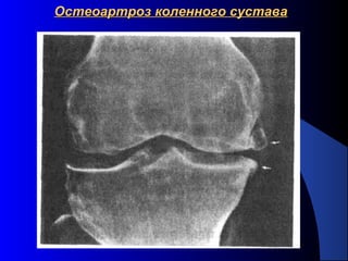 21
Остеоартроз коленного суставаОстеоартроз коленного сустава
 