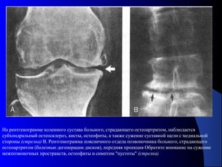 22
На рентгенограмме коленного сустава больного, страдающего остеоартритом, наблюдается
субхондральный остеосклероз, кисты, остеофиты, а также сужение суставной щели с медиальной
стороны (стрелка) В. Рентгенограмма поясничного отдела позвоночника больного, страдающего
остеоартритом (болезнью дегенерации дисков), передняя проекция Обратите внимание на сужение
межпозвоночных пространств, остеофиты и симптом "пустоты" (стрелка)
 