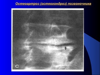 23
Остеоартроз (остеохондроз) позвоночникаОстеоартроз (остеохондроз) позвоночника
 