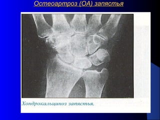 24
Остеоартроз (ОА) запястьяОстеоартроз (ОА) запястья
 