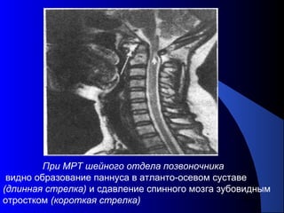 56
При МРТ шейного отдела позвоночника
видно образование паннуса в атланто-осевом суставе
(длинная стрелка) и сдавление спинного мозга зубовидным
отростком (короткая стрелка)
 