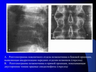 64
А. Рентгенограмма поясничного отдела позвоночника в боковой проекции,
выявляющая квадратизацию передних отделов позвонков (стрелки).
В. Рентгенограмма позвоночника в прямой проекции, показывающая
двусторонние тонкие краевые синдесмофиты (стрелки)
 