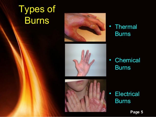 1.3.3 burns