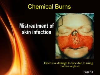 Powerpoint Templates
Page 12
Chemical Burns
Extensive damage to face due to usingExtensive damage to face due to using
corrosive pastecorrosive paste
 