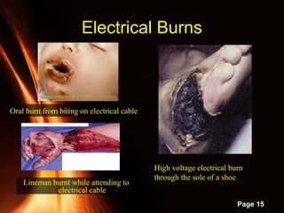 Powerpoint Templates
Page 15
Electrical BurnsElectrical Burns
Oral burn from biting on electrical cable
High voltage electrical burn
through the sole of a shoe
Lineman burnt while attending to
electrical cable
 