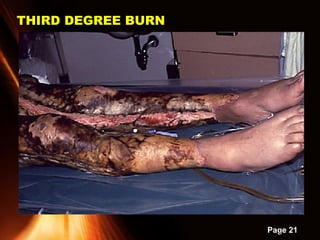 Powerpoint Templates
Page 21
THIRD DEGREE BURNTHIRD DEGREE BURN
 