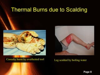 Powerpoint Templates
Page 8
Thermal Burns due to ScaldingThermal Burns due to Scalding
Leg scalded by boiling waterLeg scalded by boiling waterCasualty burnt by overheated tool
 