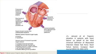 J.L. Januzzi et al. Troponin
elevation in patients with heart
failure: on behalf of the third
Universal Definition of Myocardial
Infarction Global Task Force: Heart
Failure Section. European Heart
Journal (2012) 33, 2265–2271
 